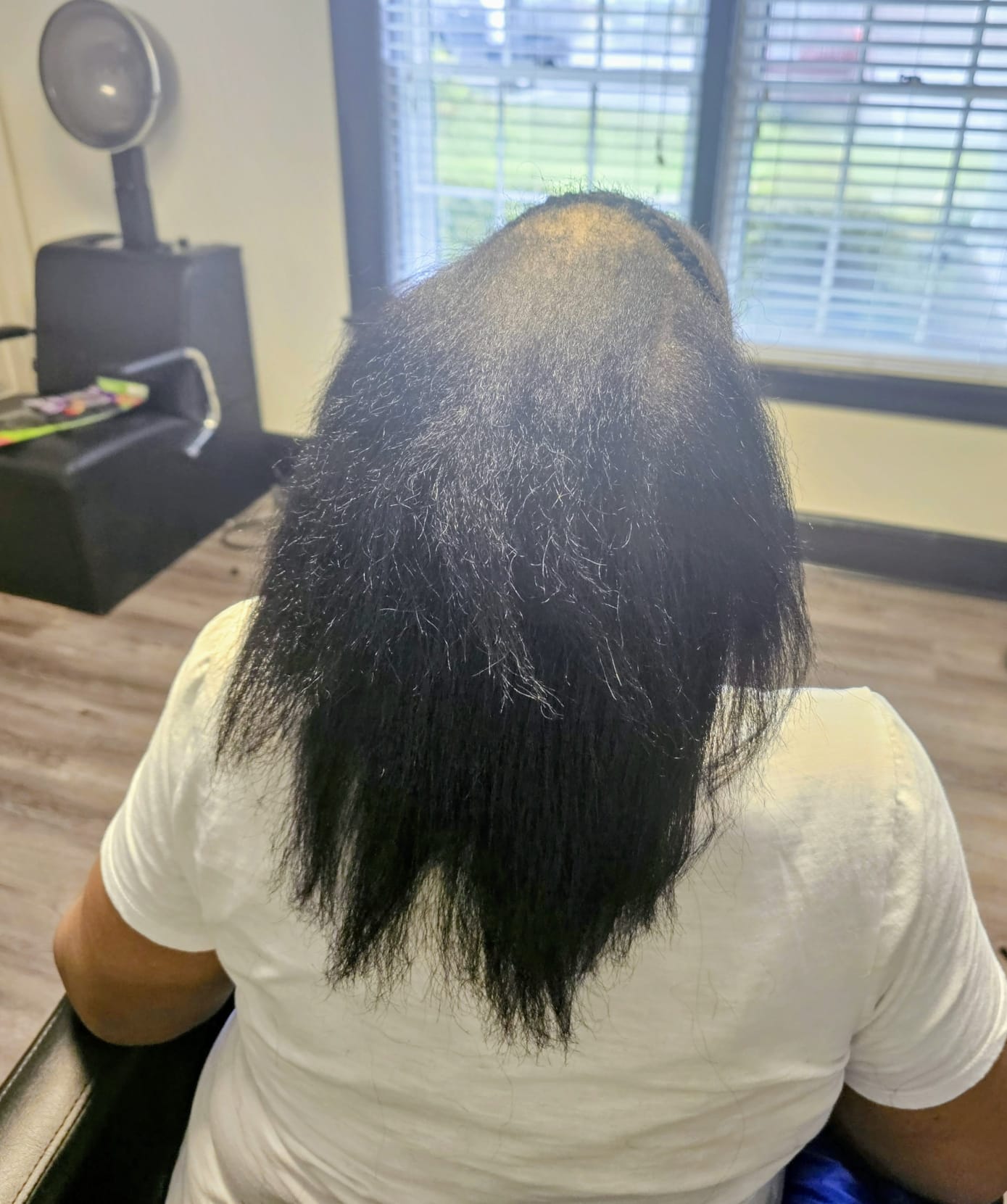 Before — alopecia hair loss